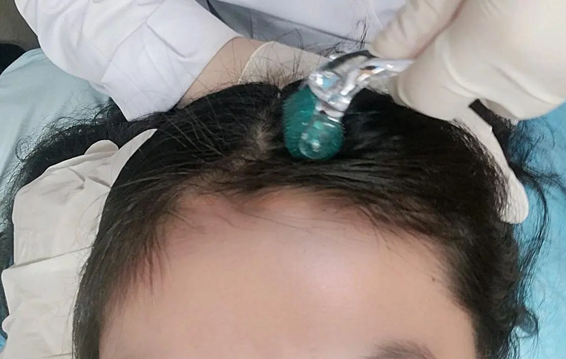 the benefit of derma roller for hair growth