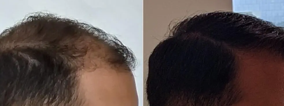 the result comparision for hair growth before and after