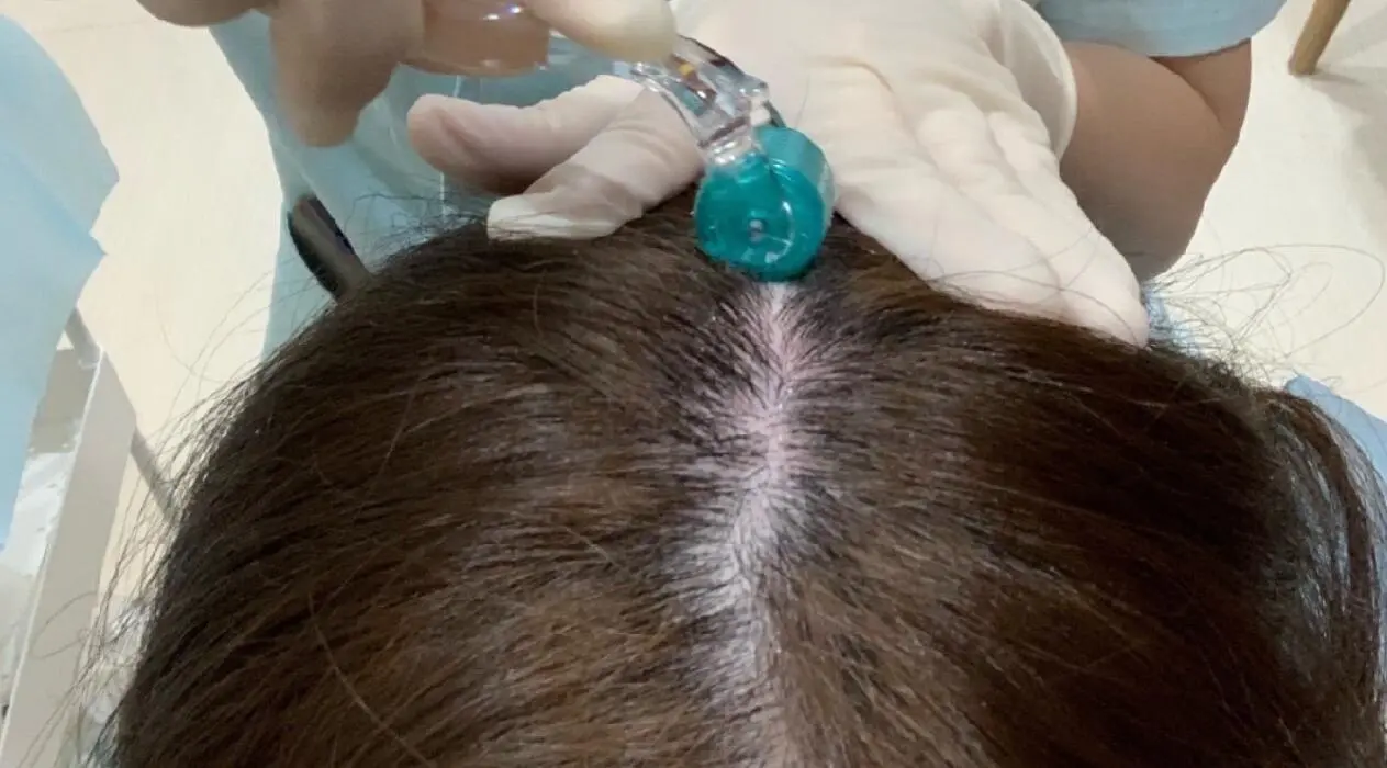 how derma roller stimulate hair growth