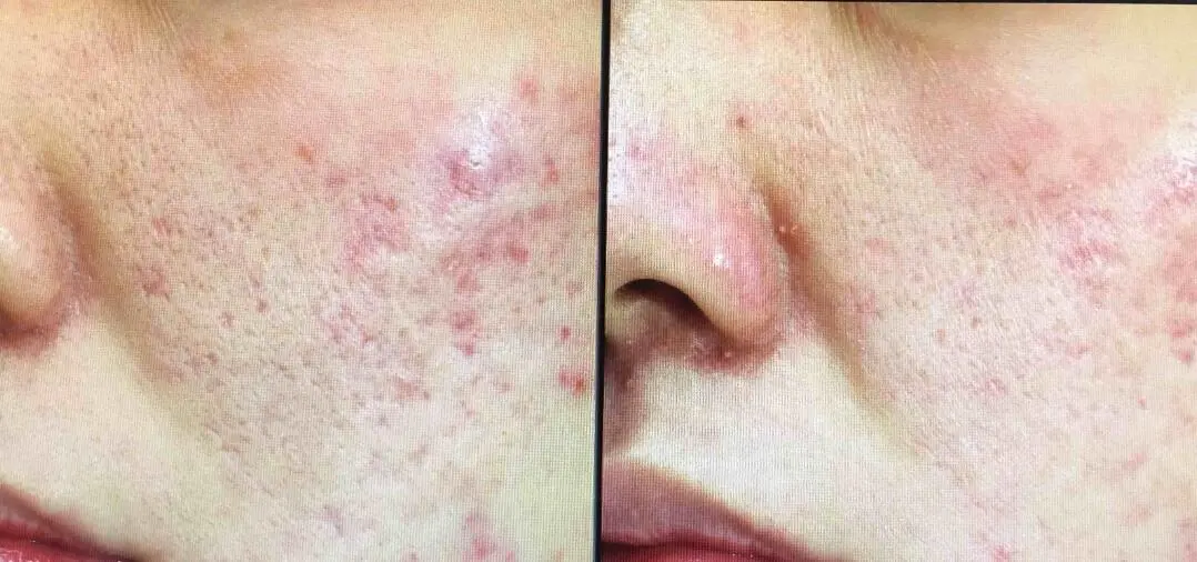 before and after results for acne skins after dermaroling