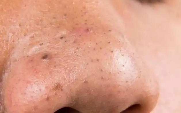 how to reduce blackheads by microneedling