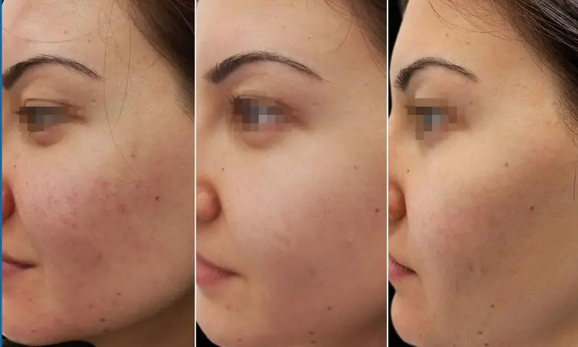 dermarolling before and after result comparision for rosacea