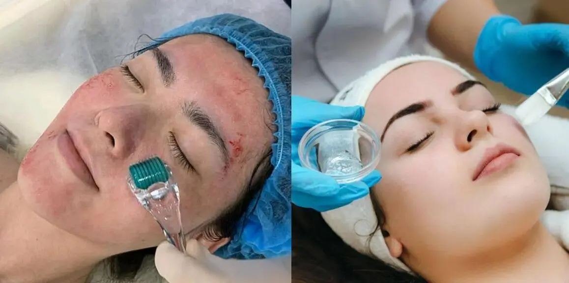 derma roller vs. chemical peel