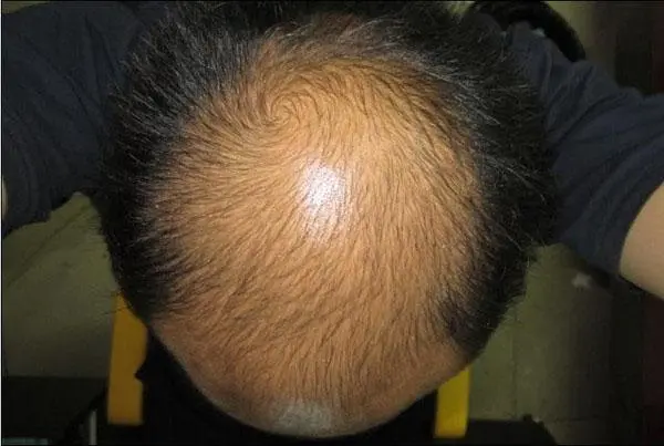 how long to see results from minoxidil for hair growth