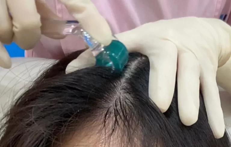 How Often Should I Use a 1.0 mm Derma Roller for Hair?