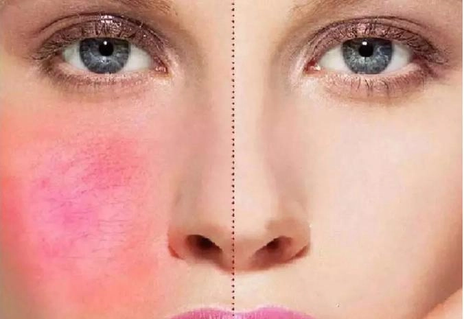 How to Use Derma Roller on Sensitive Skin Safely