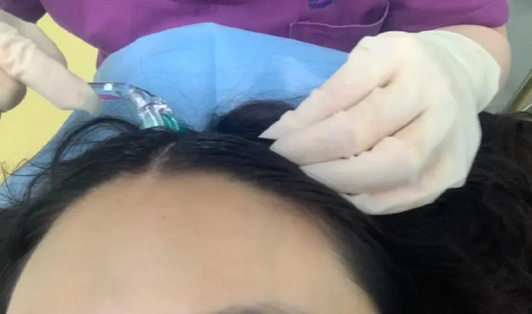 all you need to know derma roller for scalp