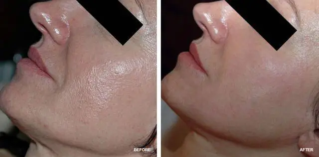 3 months microneedling result comparision before and after