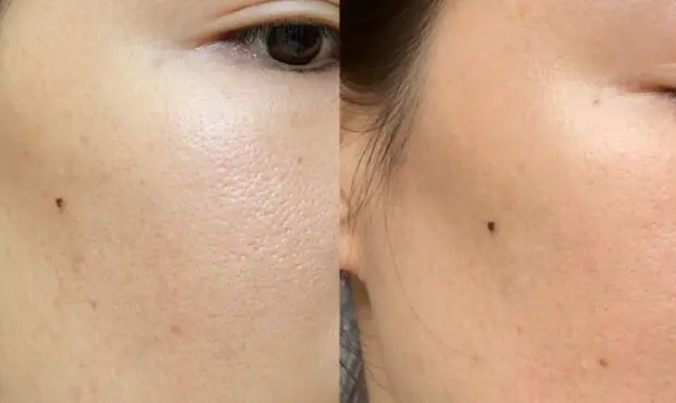 Are derma roller results permanent?