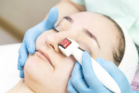 the benefits of derma roller for blackhead