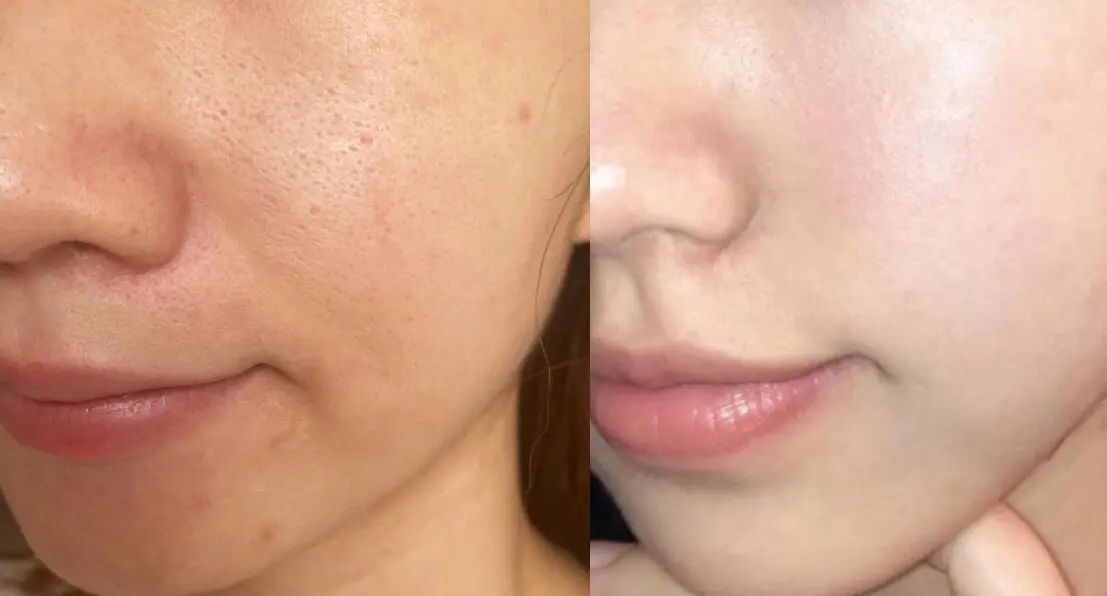 the before and after comparision of dermarolling for skin pores